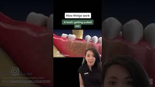 why do you need to have a bone graft done after removing a tooth⁉️