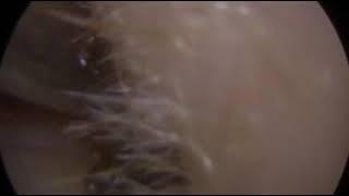 Ear wax removal - Microsuctioning