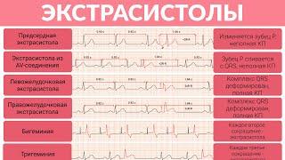 ЭКГ Разбор Экстрасистолы