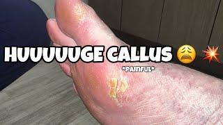 Satisfying Callus Removal: Watch This Huge Foot Callus Disappear!