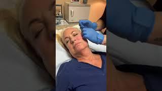 PDO Neck Lift