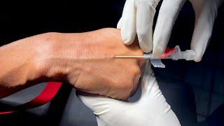 تعليم تركيب الكانيولا للمبتدئين (شرح عملي لتركيب الكانيولا)_How to Insert IV Cannula