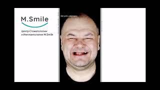 Отзыв пациента на All-on-4. M.Smile экспертная стоматология.