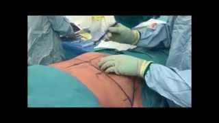 Tummy Tuck Surgery - Aurora Clinics