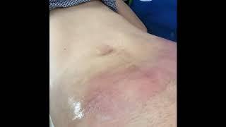 Аппендикулярный абсцесс.Appendicular abscess