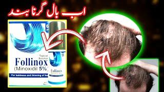 hair loss solution || #minoxidil ||  2% , 5% , 10% #ImMEDICAL