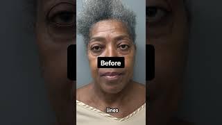 20 Years Removed!  #transformation #cosmeticsurgery #beforeandafter