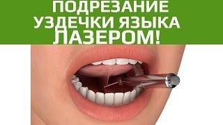 Хирургическая стоматология. Подрезание уздечки языка и губы