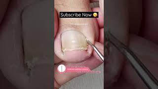 I can’t stop watching this video! #satisfying #ingrowntoenail #pedicure #pedicuretraining