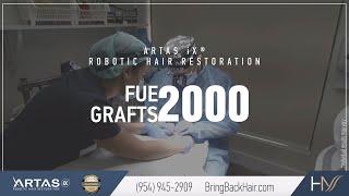 Hair By Dr. Max, Restoration Center - 2000 FUE Grafts ARTAS® Robotic Hair Restoration