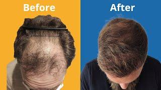 Hair Transplant Before and After - Month by Month results Elithair