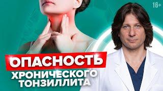 Как хронический тонзиллит влияет на весь организм. Почему его нужно лечить.