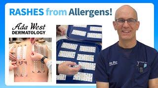 Patch testing for skin allergy in Boise with Ada West Dermatology