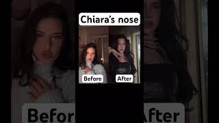 Chiara before and after nose surgery#surgery #chiara #lunatix #crewnique #zahide #germany