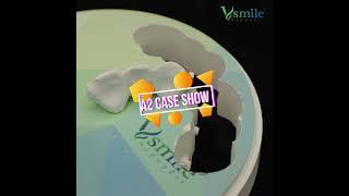 Vsmile ST Multilayer Zirconia Disc #shorts