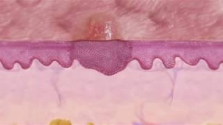 Skin Cancer: Squamous Cell Carcinoma