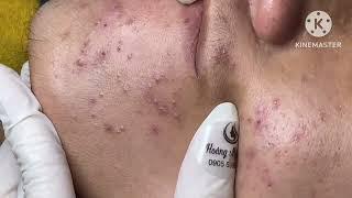 Teenage acne treatment #HoangMySpa30