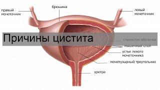 Причины цистита