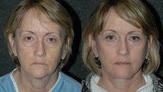 Facelift Surgery Before and After and Eyelid Lift on 60 Year Old Woman #facelift