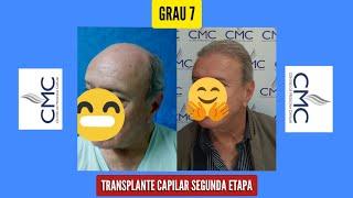 TRANSPLANTE CAPILAR GRAU 7 SEGUNDA ETAPA!!  #padraocmc ️®️