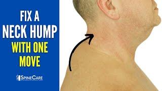 Fix a Neck Hump with One Move