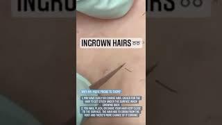 Ingrown Hairs  Nobody wants them! So how you can get rid of them?