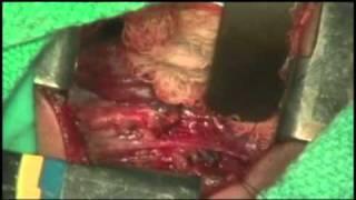 Esophageal Atresia Surgery