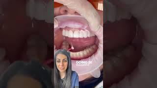 Porcelain veneers process | porcelain veneer before and after | Dr. Yazdan | natural looking veneers