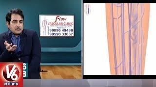 Varicose Veins Problem | Symptoms & Treatment | Dr. Abhilash | Good Health | V6 News