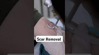 How to Get Rid of Scars | Procedure for Scar Removal | #Scarremoval #DrSridevi