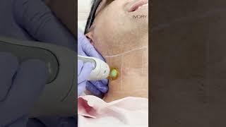 Laser Beard Shaping - Ivory Aesthetics Clinic Dubai