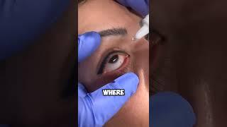 How remove tattoo from eyelid