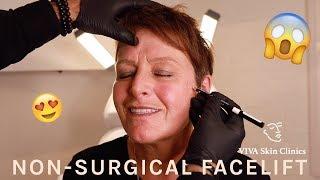 Juvéderm Non-Surgical Facelift | VIVA Skin Clinics