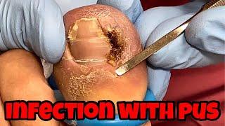 INFECTED INGROWN TOENAIL EXTRACTION