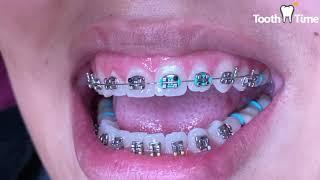 How to avoid getting braces again - braces on - Tooth Time Family Dentistry New Braunfels