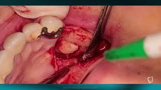 Sinus floor elevation(sinus lifting)in difficult clinical case  (IMPLANTOLOGIST Dr. EMIL IMANOV)