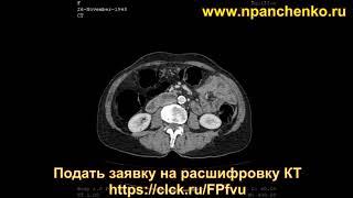 Расшифровка КТ брюшной полости с контрастированием показала кисты (метастазы) в печени