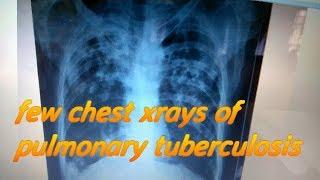 chest xray PA view of pulmonary tuberculosis.