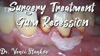 Gum recession surgery treatment. Dr. Venci Stankov