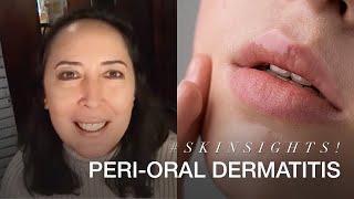 Peri-Oral Dermatitis | VMV Hypoallergenics Snippet