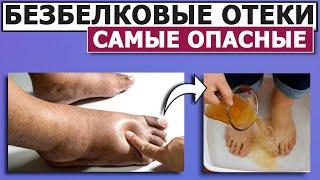  Самые тяжёлые ОТЁКИ  безбелковые