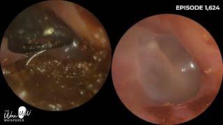 1,624 - Learn How I Remove Ear Wax in a Patient with Severe Tinnitus | Curette Technique Explained