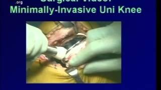 Minimally Invasive Joint Replacement
