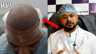 Best Hair Transplant Surgeon in MP(INDIA)|| Best Hair Transplant IN India,Hair Transplant Results.