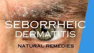 TREAT SEBORRHEIC DERMATITIS with NATURAL REMEDIES