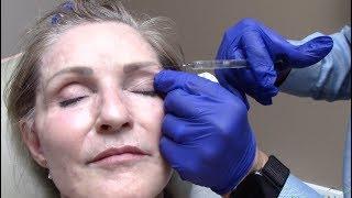 Sunken Eye Treatment | Utah Valley Dermatology