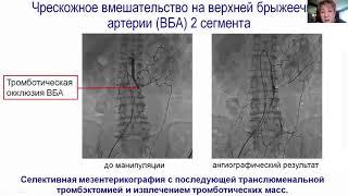 Клинический разбор  Эмболический с-м у пациента с постоянной формой ФП