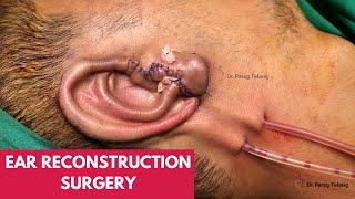 Microtia reconstruction by Dr Parag Telang