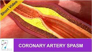 CORONARY ARTERY SPASM