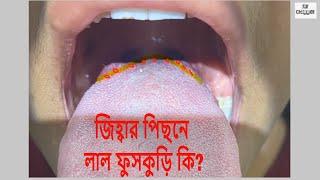 জিহ্বার পিছনে লাল ফুসকুড়ি কি? Red bumps behind tongue ?